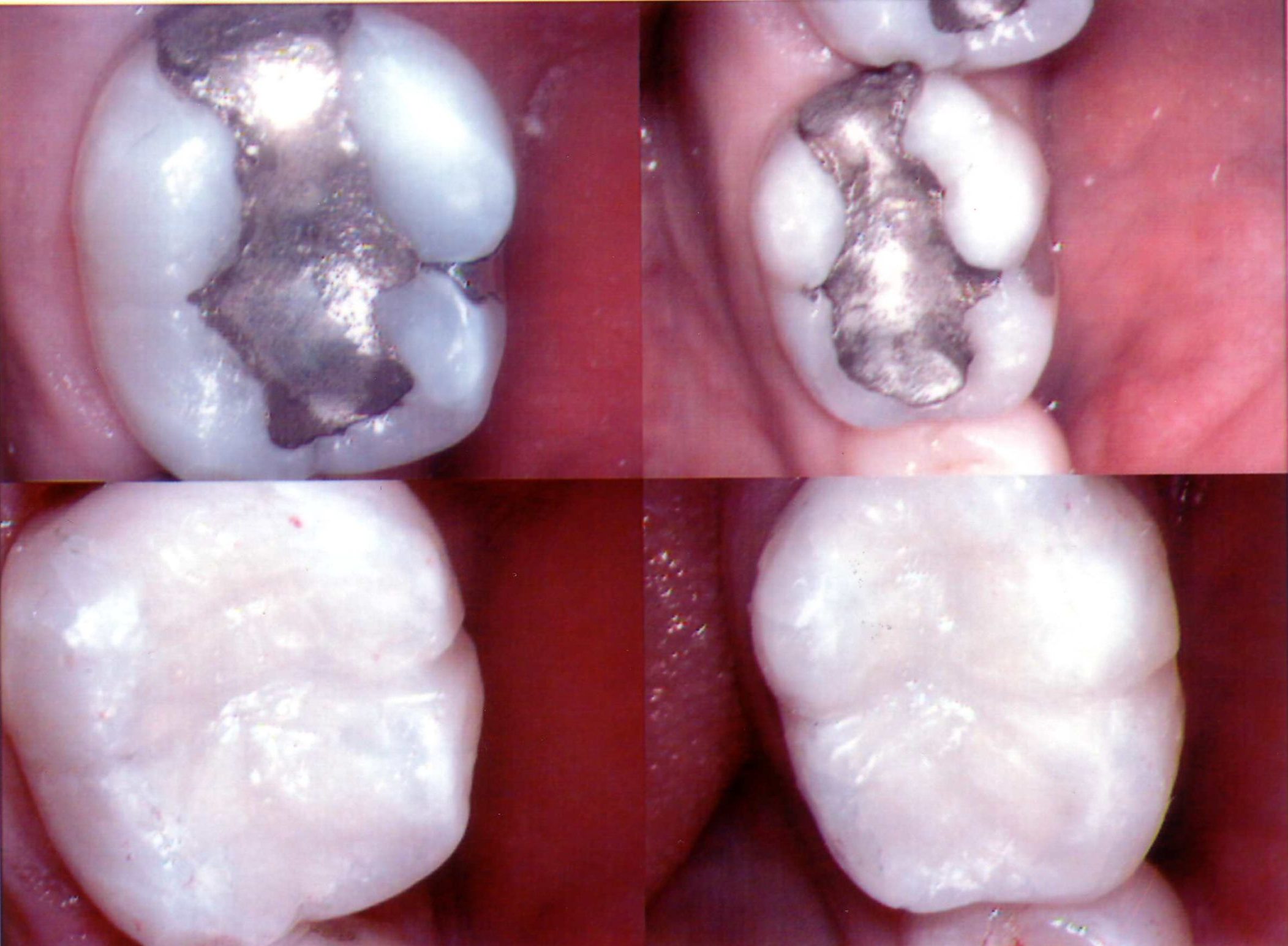 Remove mercury filling by Livermore dentist