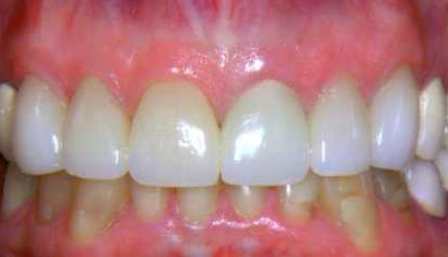 Cosmetic dentist Livermore CA after treatment