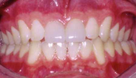 White teeth after Livermore cosmetic dentist treatment